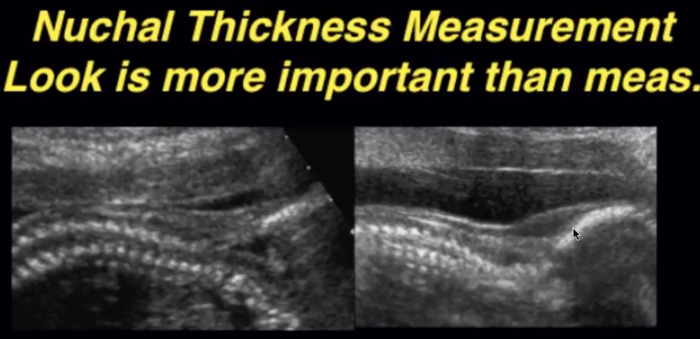 Thickness ultrasound nuchal What to